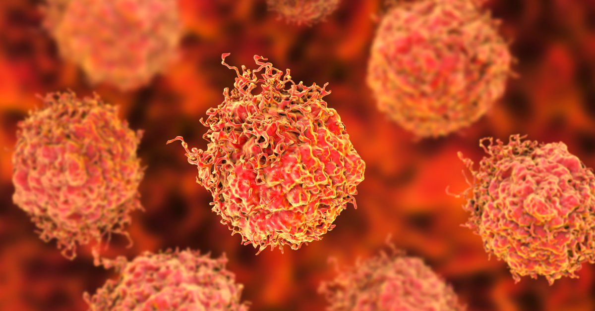 Decoding A Gleason Score Of 9: Implications For Prostate Cancer Decoding A Gleason Score Of 9: Implications For Prostate Cancer