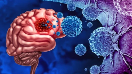Patrick Soon-Shiong On Glioblastoma: Hope And Progress In Cancer Treatment Patrick Soon-Shiong On Glioblastoma: Hope And Progress In Cancer Treatment